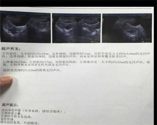 广州不孕不育医院哪家好：注意！胎停育症状表